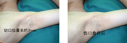  改良小切口汗腺清除术改良小切口汗腺清除术前后对比.GIF